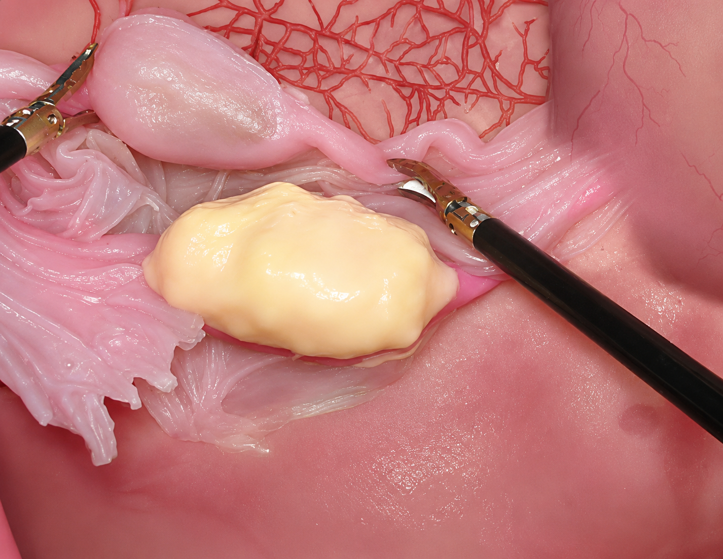 Salpingectomy