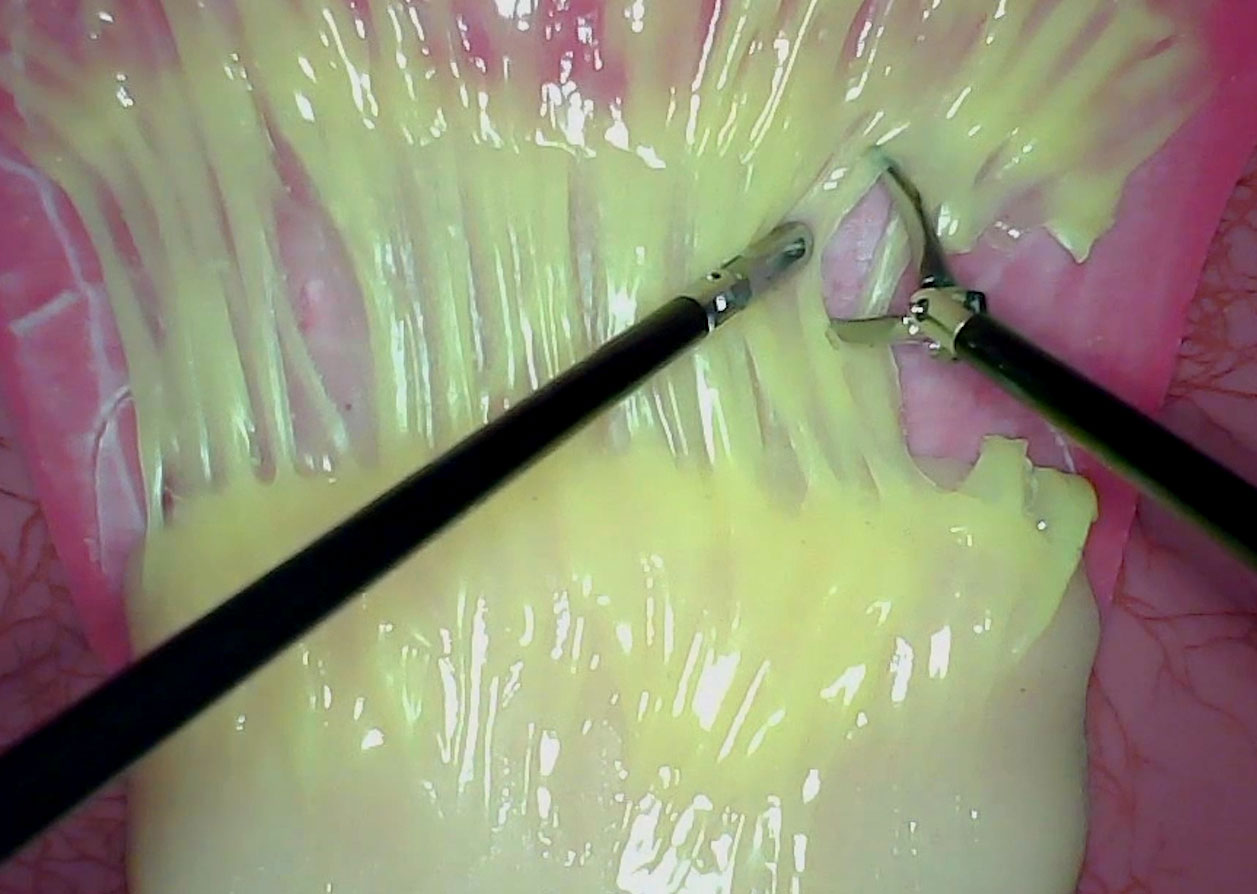 Adhesiolysis