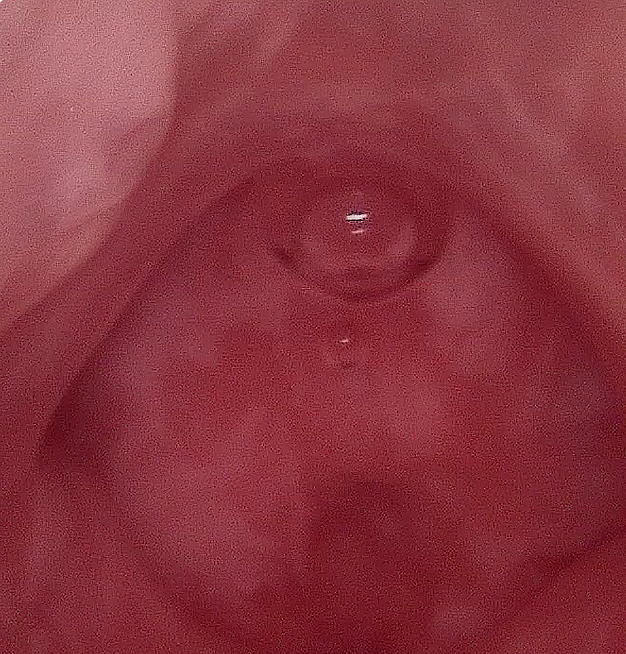 Hysteroscopic Visual D&C