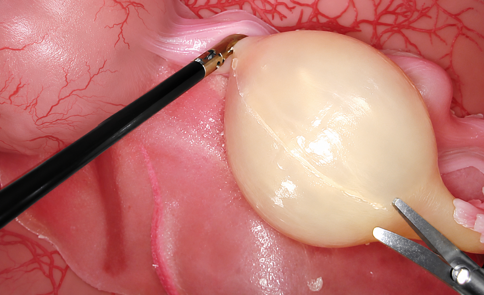 Ovarian Cystectomy