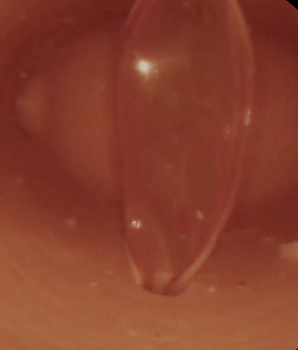 Hysteroscopic Adhesiolysis