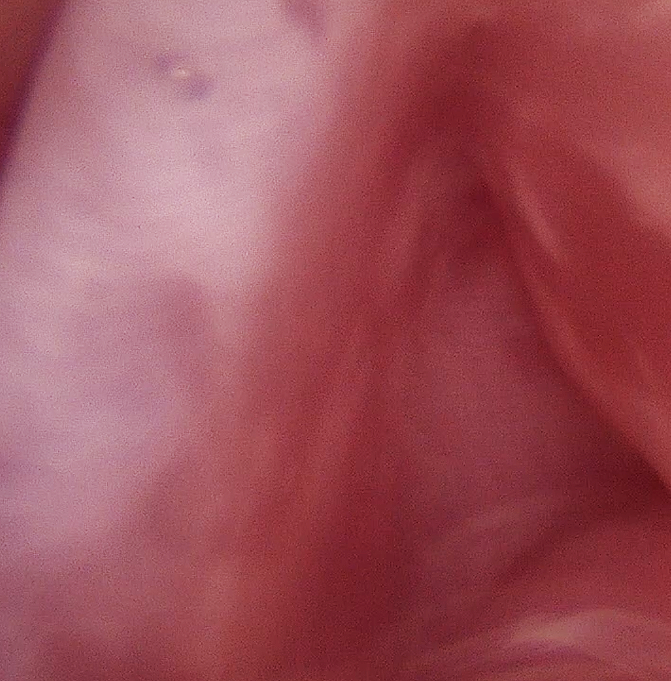 Hysteroscopic Septum