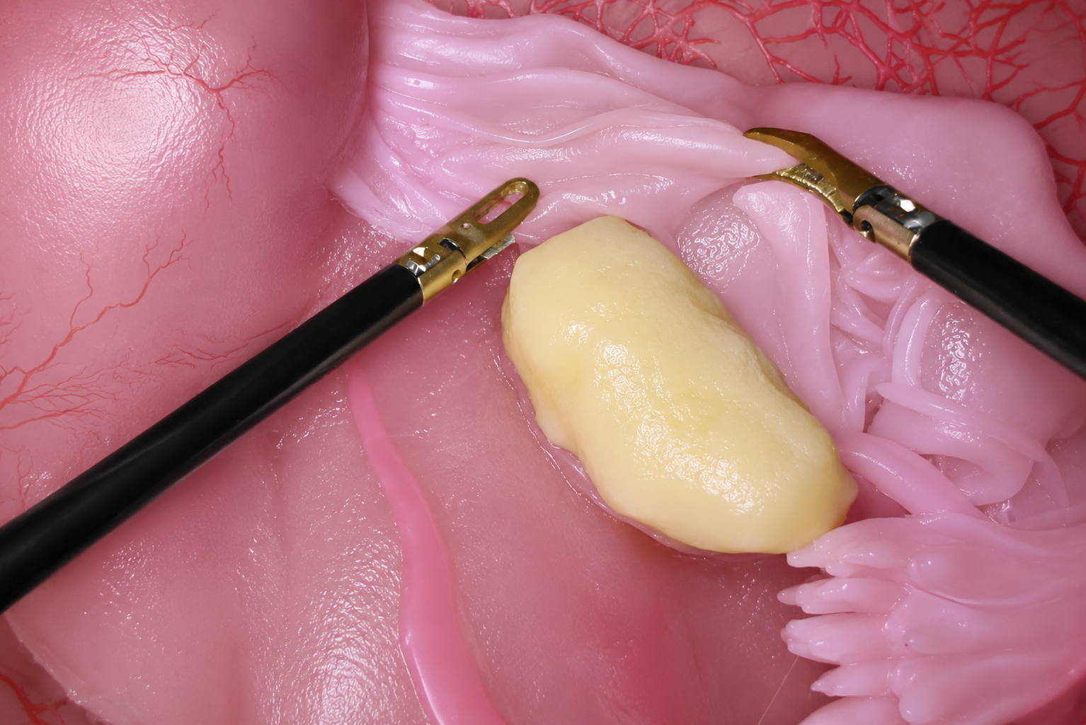 Salpingostomy