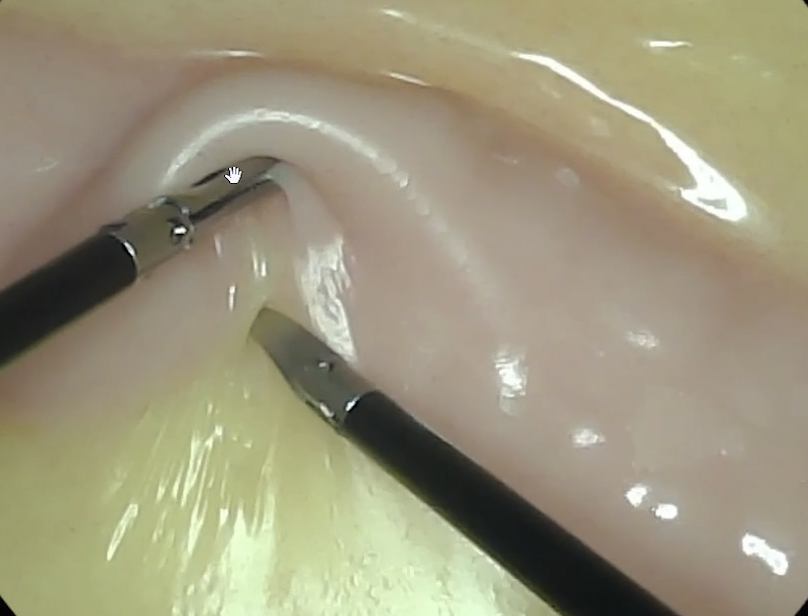 Mesocolic Dissection