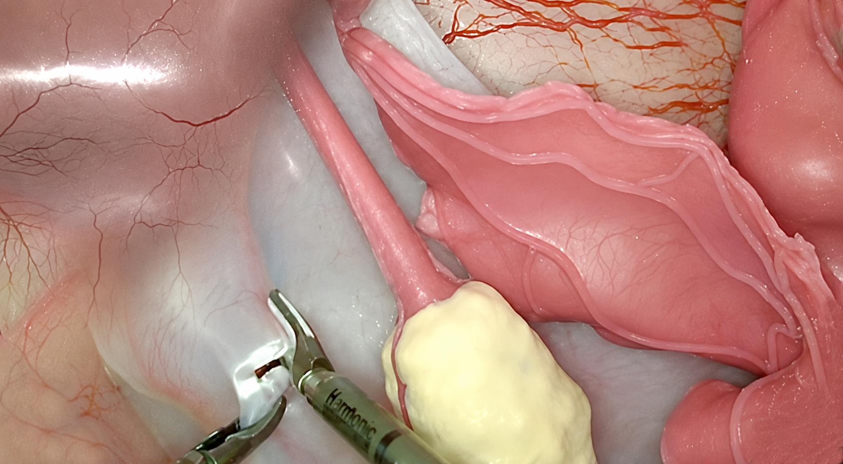 Pelvic Side Wall Dissection