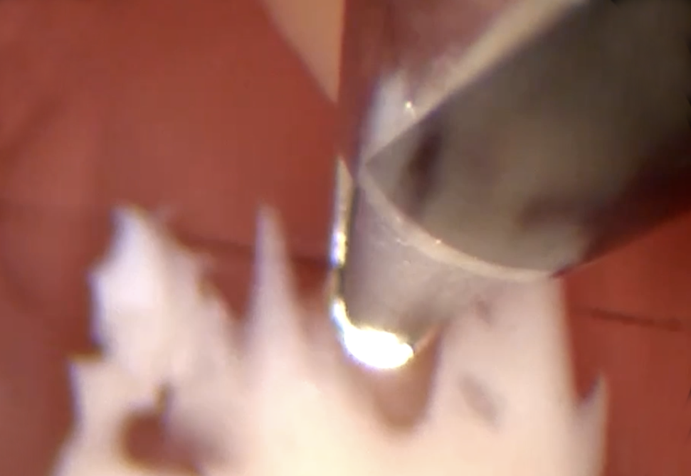 Hysteroscopic Fibroid Removal