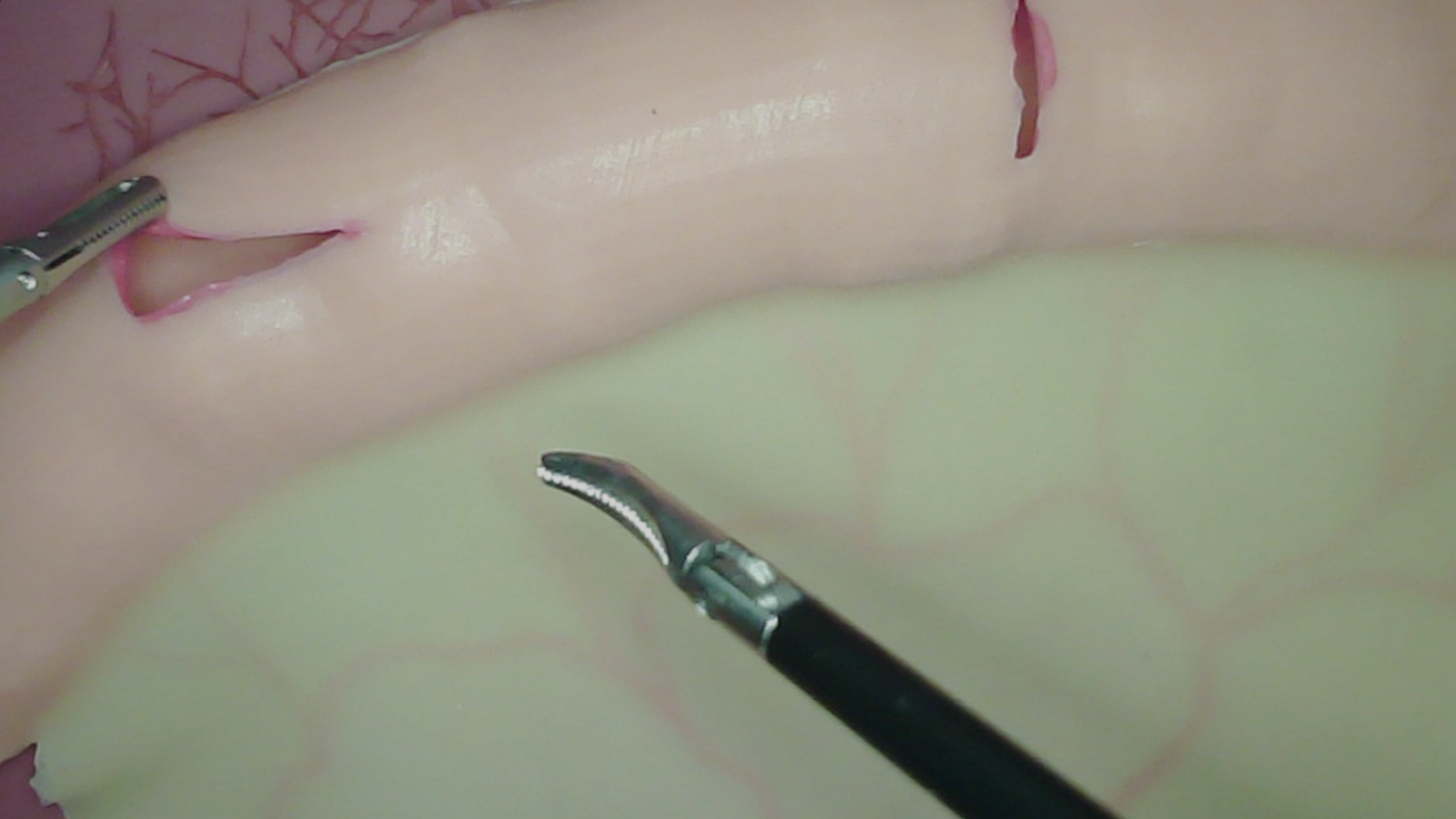 Bowel Enterotomy