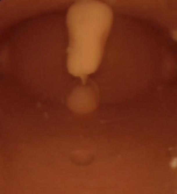 Hysteroscopic Polypectomy - Dry Lab