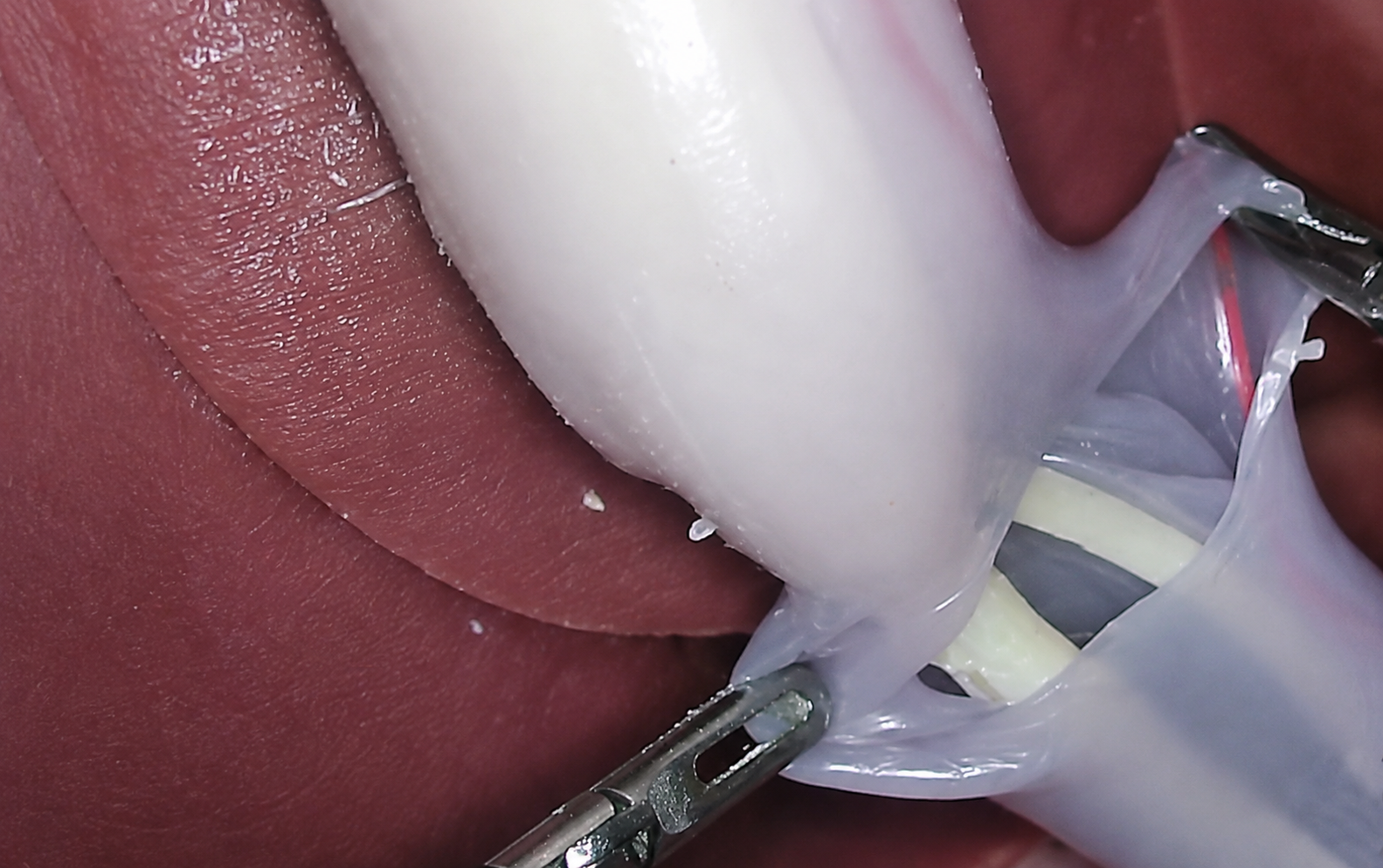 Cholecystectomy
